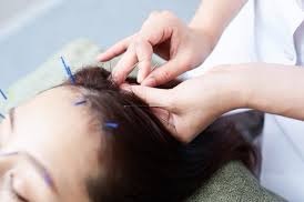 辛い頭痛は鍼灸治療にお任せ！ 鍼灸治療の効果について