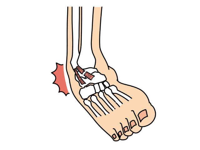 新松戸で捻挫・肉離れなら｜再発予防まで見据えた施術
